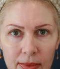 Feel Beautiful - Eyelids 114 - After Photo